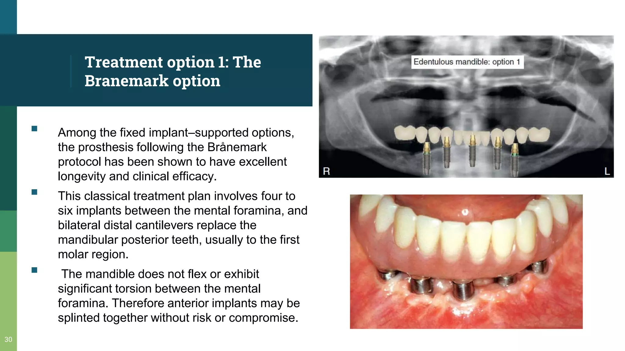 prosthetic options in implant | PPTX