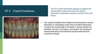 Fixed Prostheses
10
FP 3
The FP-3 fixed restoration appears to replace the
natural teeth crowns and has pink-colored
restorative materials to replace a portion of the soft
tissue.
• The original available bone height has decreased by natural
resorption or osteoplasty at the time of implant placement.
• To place the incisal edge of the teeth in proper position for
esthetics, function, lip support, and speech, the excessive
vertical dimension to be restored requires teeth that are
unnatural in length.
 