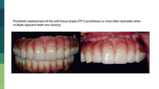 13
Prosthetic replacement of the soft tissue drape (FP-3 prosthesis) is most often desirable when
multiple adjacent teeth are missing
 