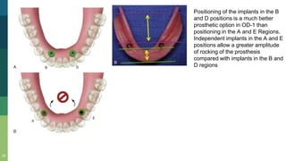 20
Positioning of the implants in the B
and D positions is a much better
prosthetic option in OD-1 than
positioning in the A and E Regions.
Independent implants in the A and E
positions allow a greater amplitude
of rocking of the prosthesis
compared with implants in the B and
D regions
 