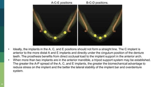 23
• Ideally, the implants in the A, C, and E positions should not form a straight line. The C implant is
anterior to the more distal A and E implants and directly under the cingulum position of the denture
teeth. The prosthesis benefits from direct occlusal load to the implant support in the anterior arch.
• When more than two implants are in the anterior mandible, a tripod support system may be established.
The greater the A-P spread of the A, C, and E implants, the greater the biomechanical advantage to
reduce stress on the implant and the better the lateral stability of the implant bar and overdenture
system.
A-C-E positions B-C-D positions.
 