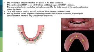 25
• The overdenture attachments often are placed in the distal cantilevers.
• The prosthesis is still RP-5, but with the least soft tissue support of all RP-5 designs.
• The anterior attachment must allow vertical movement for the distal aspect of the prosthesis to rotate
toward the tissue.
• Clips, which permit rotation, are difficult to use on cantilevered superstructures.
• The clip must be placed perpendicular to the path of rotation to allow movement, not along the
cantilevered bar, where its only function then is retention.
 