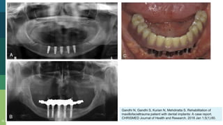 32
Gandhi N, Gandhi S, Kurian N, Mehdiratta S. Rehabilitation of
maxillofacialtrauma patient with dental implants: A case report.
CHRISMED Journal of Health and Research. 2018 Jan 1;5(1):80.
 