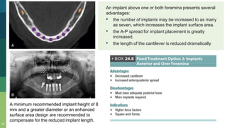 An implant above one or both foramina presents several
advantages:
• the number of implants may be increased to as many
as seven, which increases the implant surface area.
• the A-P spread for implant placement is greatly
increased.
• the length of the cantilever is reduced dramatically
34
A minimum recommended implant height of 8
mm and a greater diameter or an enhanced
surface area design are recommended to
compensate for the reduced implant length.
 