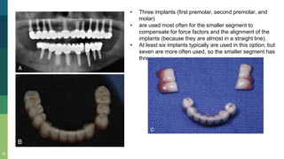 38
• Three implants (first premolar, second premolar, and
molar)
• are used most often for the smaller segment to
compensate for force factors and the alignment of the
implants (because they are almost in a straight line).
• At least six implants typically are used in this option, but
seven are more often used, so the smaller segment has
three implants.
 