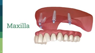 41
Maxilla
 