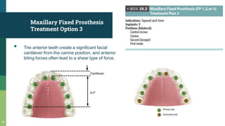 Maxillary Fixed Prosthesis
Treatment Option 3
▪ The anterior teeth create a significant facial
cantilever from the canine position, and anterior
biting forces often lead to a shear type of force.
49
 
