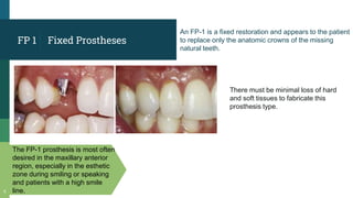 Fixed Prostheses
The FP-1 prosthesis is most often
desired in the maxillary anterior
region, especially in the esthetic
zone during smiling or speaking
and patients with a high smile
line.
5
FP 1
An FP-1 is a fixed restoration and appears to the patient
to replace only the anatomic crowns of the missing
natural teeth.
There must be minimal loss of hard
and soft tissues to fabricate this
prosthesis type.
 