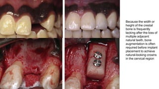 6
Because the width or
height of the crestal
bone is frequently
lacking after the loss of
multiple adjacent
natural teeth, bone
augmentation is often
required before implant
placement to achieve
natural-looking crowns
in the cervical region
 
