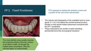 Fixed Prostheses
7
FP 2
• The volume and topography of the available bone is more
apical  1 to 2 mm below the cement-enamel junction
Dictate a more apical implant placement compared with
the FP-1 prosthesis.
• These restorations are similar to teeth exhibiting
periodontal bone loss and gingival recession
FP-2 appears to restore the anatomic crown and
a portion of the root of the natural tooth.
The most esthetic area usually requires
the incisal two-thirds of the two crowns
to be ideal in width, as though the
implant were not present. Only the
cervical region is compromised.
 