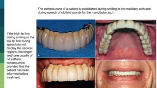 9
The esthetic zone of a patient is established during smiling in the maxillary arch and
during speech of sibilant sounds for the mandibular arch.
If the high lip line
during smiling or the
low lip line during
speech do not
display the cervical
regions, the longer
teeth are usually of
no esthetic
consequence,
provided that the
patient has been
informed before
treatment.
 