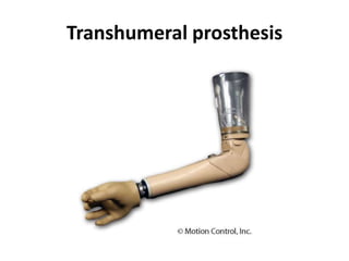 Transhumeral prosthesis

 