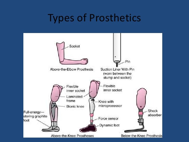 Prosthetic arm types image