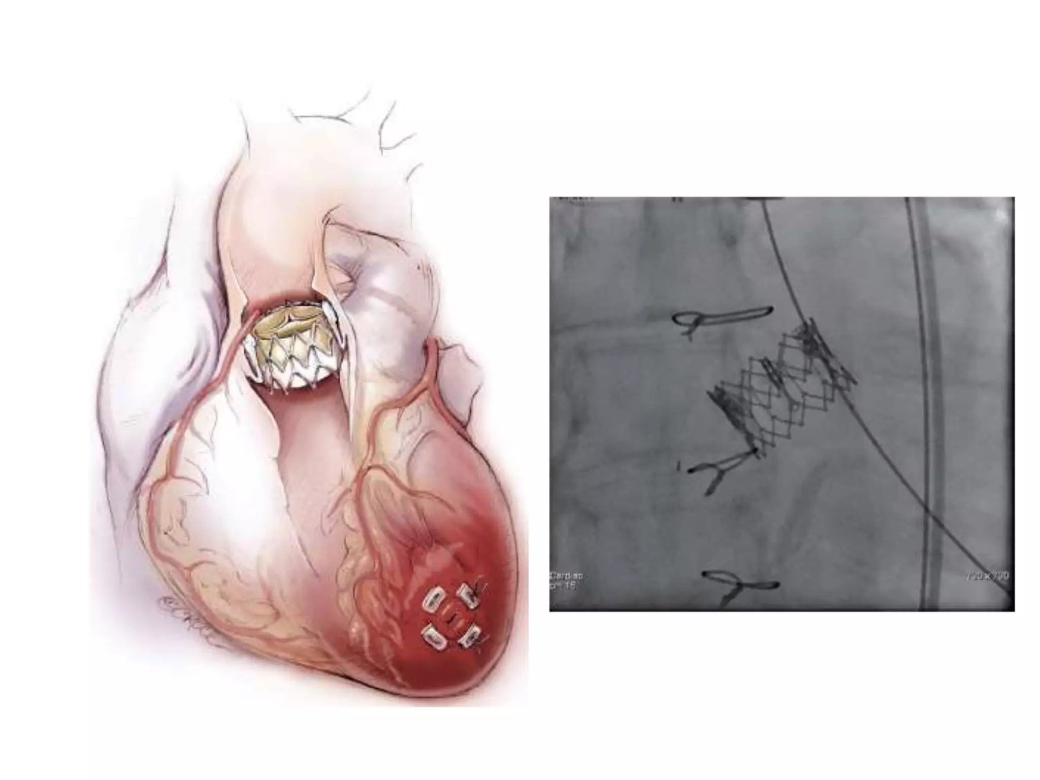 Commando Prothesis Cardiac Prosthetic cardiac valves | PPTX
