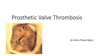 Prosthetic Valve Thrombosis
Dr. Khine Thazin Myint
 