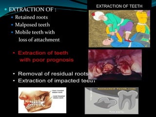 PRE PROSTHETIC FULL MOUTH PREPARATION | PPTX