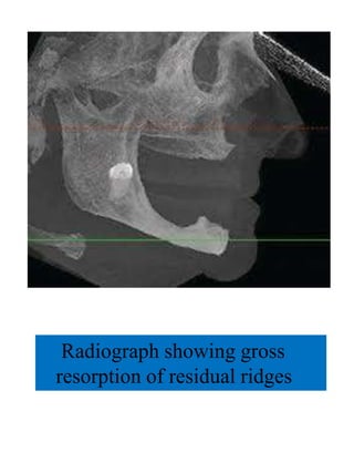 Radiograph showing gross
resorption of residual ridges
 