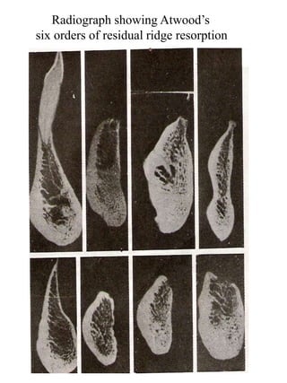 Radiograph showing Atwood’s
six orders of residual ridge resorption
 