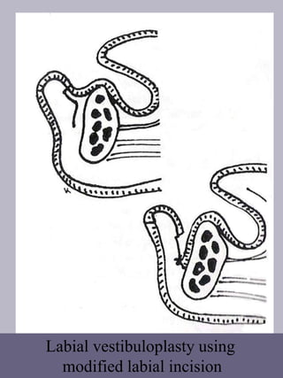 Labial vestibuloplasty using
modified labial incision
 