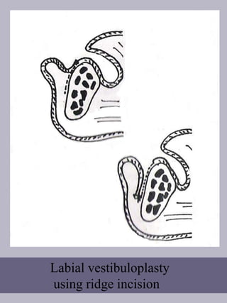 Labial vestibuloplasty
using ridge incision
 