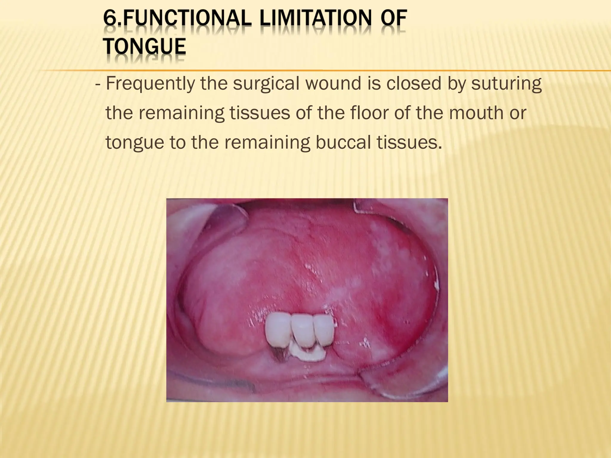 - Frequently the surgical wound is closed by suturing
the remaining tissues of the floor of the mouth or
tongue to the remaining buccal tissues.
 