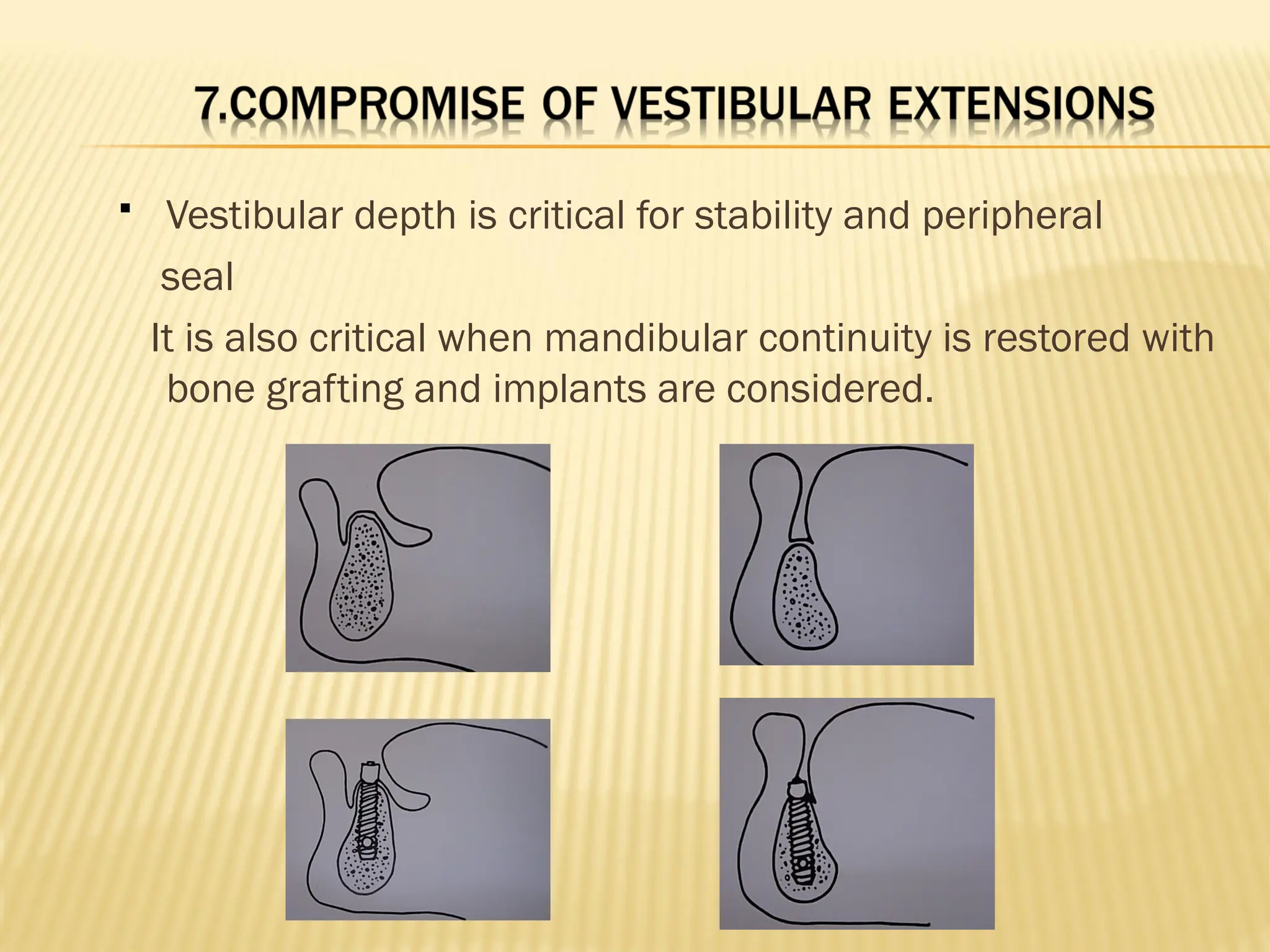  Vestibular depth is critical for stability and peripheral
seal
It is also critical when mandibular continuity is restored with
bone grafting and implants are considered.
 