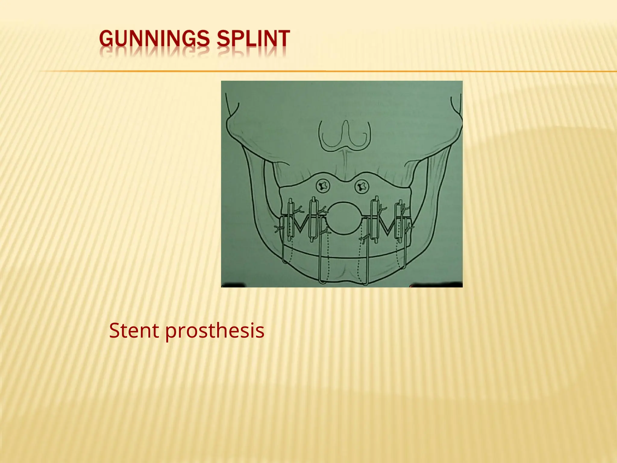 Stent prosthesis
 