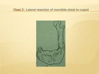 Class 2 : Lateral resection of mandible distal to cuspid
 