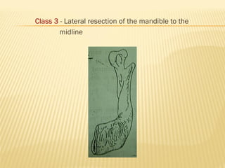 Class 3 - Lateral resection of the mandible to the
midline
 