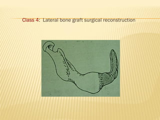 Class 4: Lateral bone graft surgical reconstruction
 