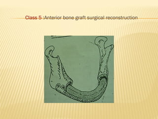 Class 5 :Anterior bone graft surgical reconstruction
 