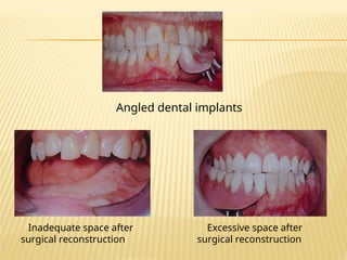 Angled dental implants
Inadequate space after
surgical reconstruction
Excessive space after
surgical reconstruction
 