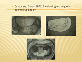  Cantor and Curtis(1971):Swallowing technique in
edentulous patient
 