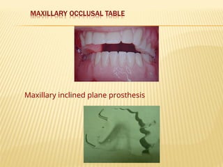 Maxillary inclined plane prosthesis
 