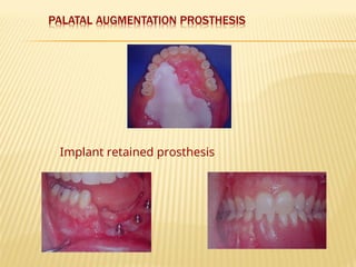 Implant retained prosthesis
 