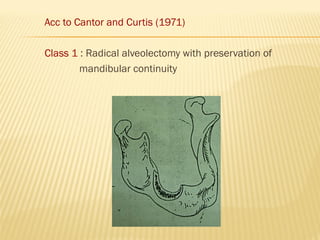 Acc to Cantor and Curtis (1971)
Class 1 : Radical alveolectomy with preservation of
mandibular continuity
 