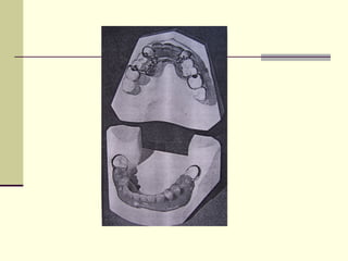 Abc Defects Prosthodontic management of acquired defects of mandible123.ppt