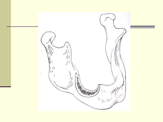 Abc Defects Prosthodontic management of acquired defects of mandible123.ppt