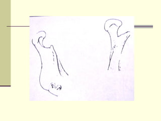 Abc Defects Prosthodontic management of acquired defects of mandible123.ppt