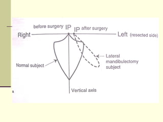 Abc Defects Prosthodontic management of acquired defects of mandible123.ppt