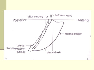 Abc Defects Prosthodontic management of acquired defects of mandible123.ppt