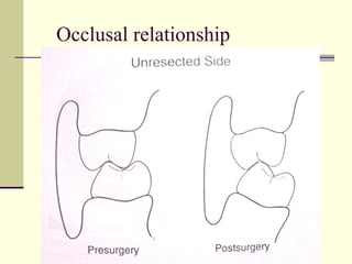Abc Defects Prosthodontic management of acquired defects of mandible123.ppt