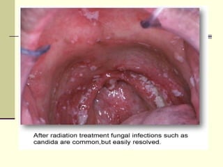 Abc Defects Prosthodontic management of acquired defects of mandible123.ppt