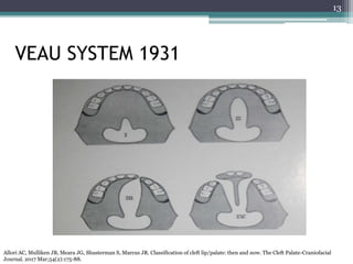 Veau Classfication Prosthodontic management of cleft lip and palate | PPTX