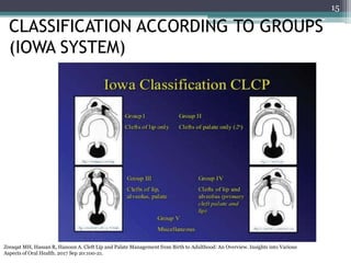 Prosthodontic management of cleft lip and palate | PPTX