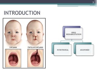 Prosthodontic management of cleft lip and palate | PPTX