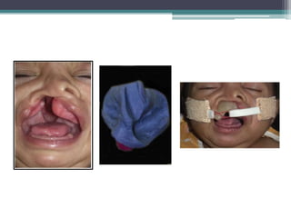 Prosthodontic management of cleft lip and palate | PPTX