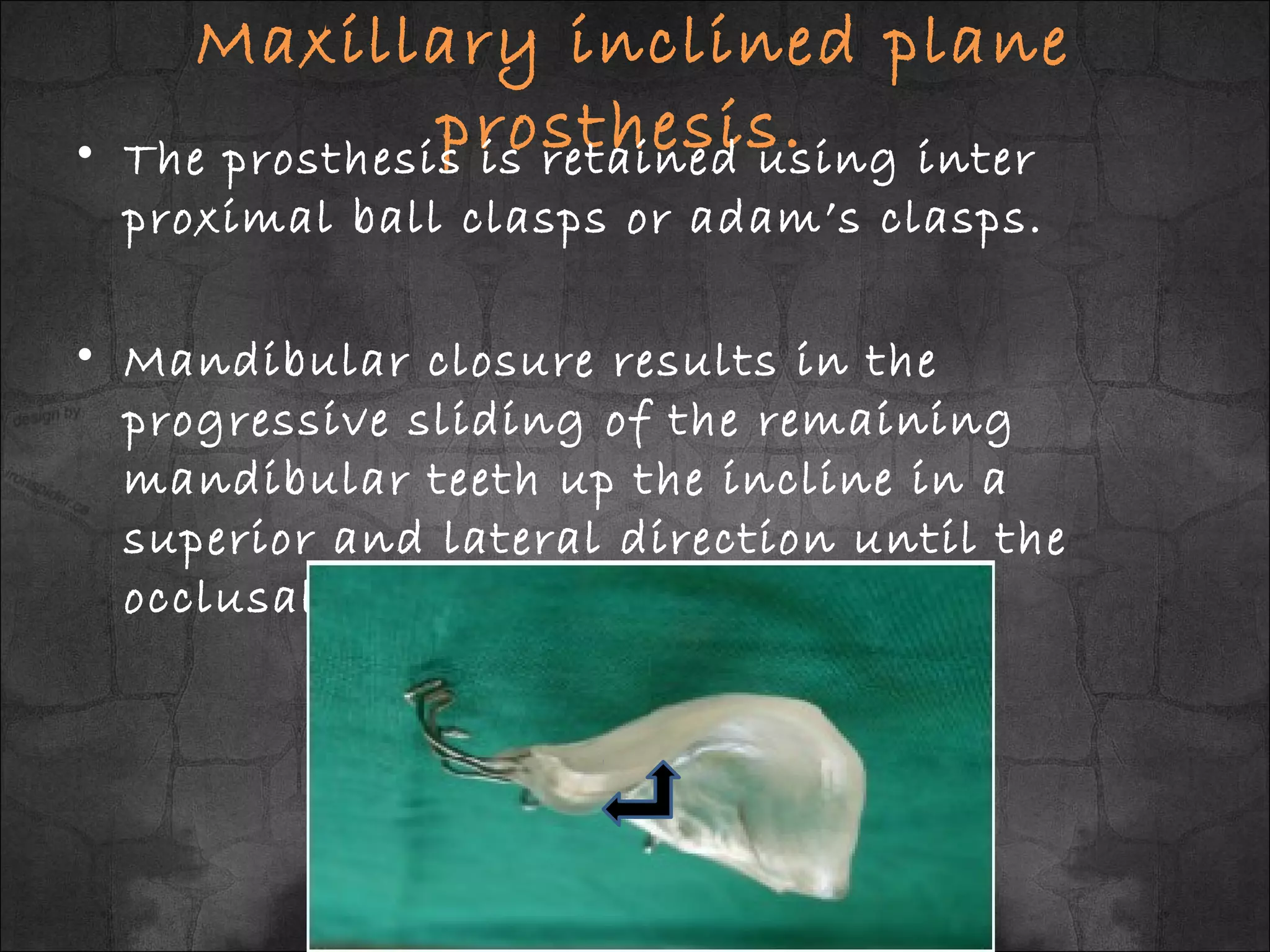 Teeth Incliners Prosthodontic Management of Mandibular Defects | PPT