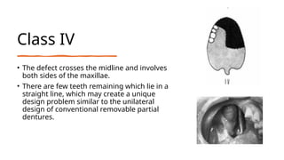 PROSTHODONTIC MANAGEMENT OF PATIENT TREATED SURGICALLY FOR CARCINOMA.pptx