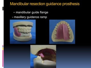 Maxillary Ramps Prosthodontic rehabilitation of mandibulectomy | PPTX